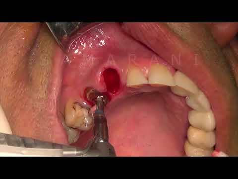 Benex-Control (extraction de racines), CBE00
